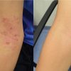 rash before and after