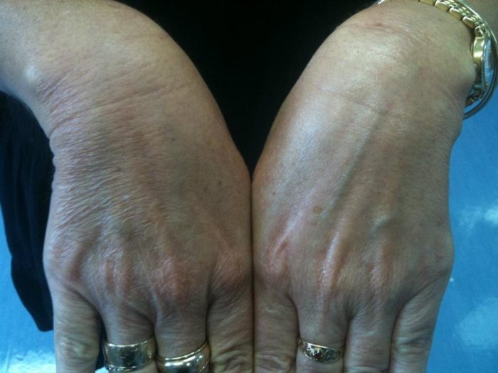 before after hands 2 1